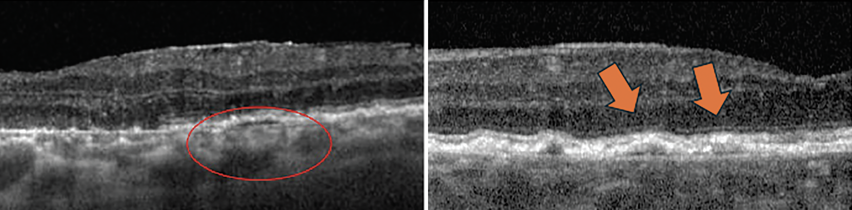 Fig. 9. Double-layer sign is seen within the circle and marked by arrows in these two OCT cross-sections.