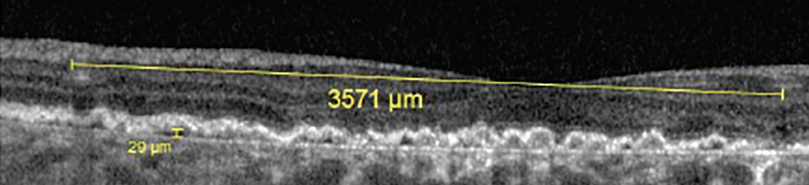 Fig. 10. This shallow irregular RPE elevation was more than 3,500μm in length and only 29μm in height. 