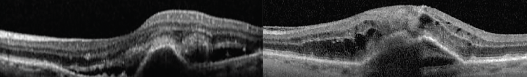 Fig. 12. Two case examples of type 1 MNV showing a pigment epithelial detachment and sub- and intraretinal fluid.