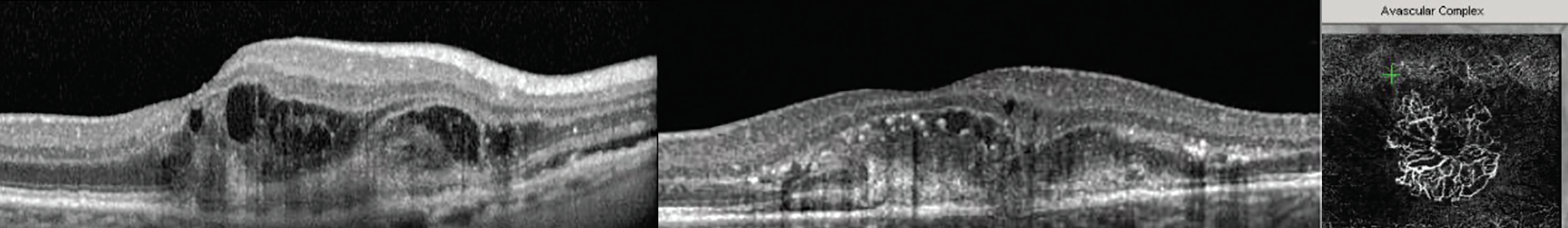 Fig. 13. These two examples of type 2 MNV show lesions that penetrated Bruch’s membrane and are invading the subretinal space. The OCT-A on the right shows the abnormal vessel growth causing the morphological damage seen in the corresponding OCT cross-section.