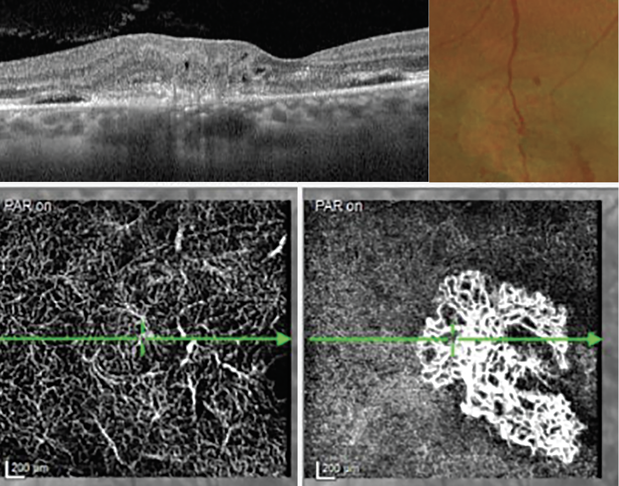 Fig. 14. These images demonstrate a type 3 MNV or a retinal angiomatous proliferation lesion on OCT. In the color fundus photograph (top right), the collateral retinal vessels are seen in the center on the neovascular lesion. The OCT-A images show capillary telangiectasia in the deep vascular plexus and the large MNV at the avascular level (bottom right).