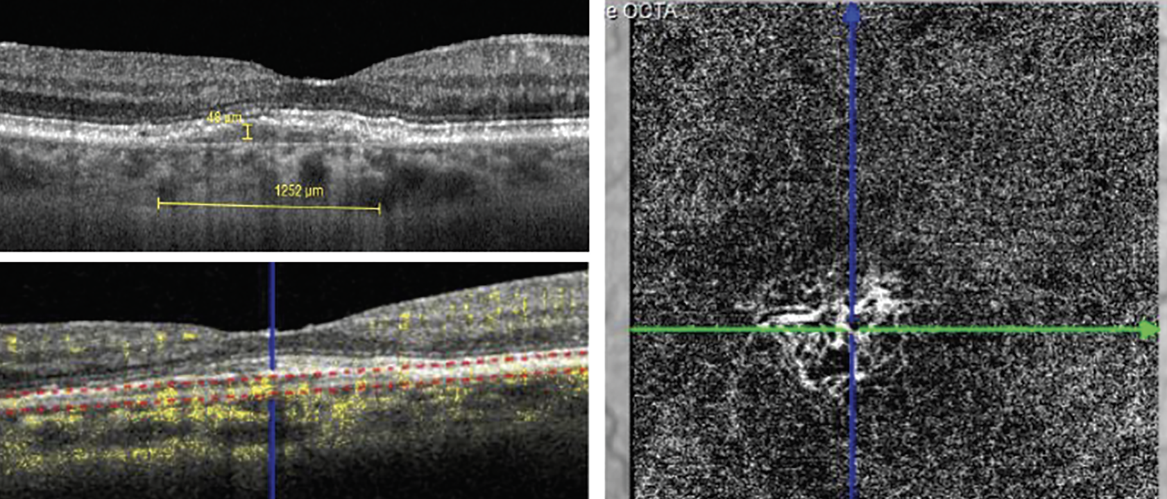 Fig. 11. Comparison of a shallow irregular RPE elevation with OCT B-scan to OCT-A, which reveals nonexudative MNV.