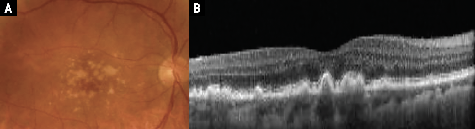 Fig. 2a-b. Intermediate AMD demonstrating large-sized drusen (>125μm). 