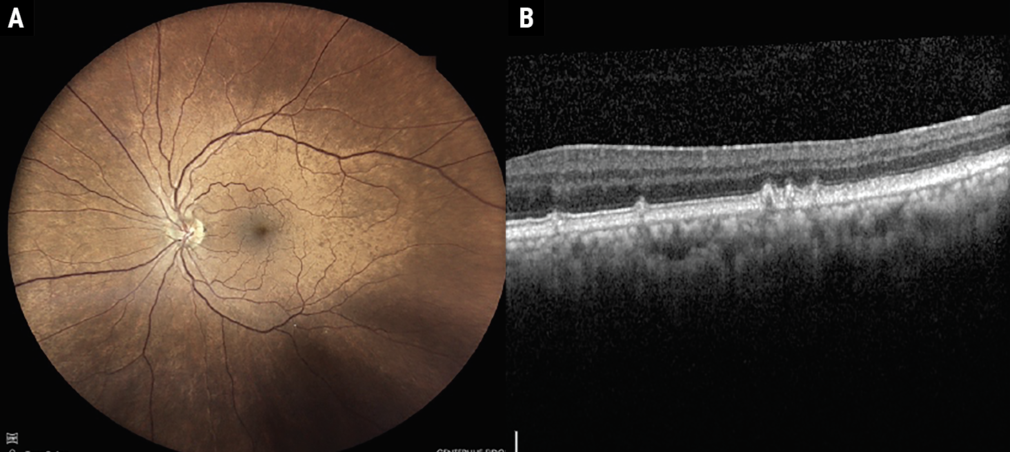 Fig. 3a-b. Fundus photo and OCT demonstrating cuticular drusen.