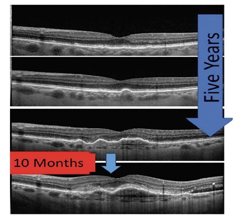 Fig. 4. This series of OCT images demonstrates slow progression of AMD from early to intermediate over five years; however, with increased drusen volume and development of pigment epithelial detachments, the patient converted from dry to neovascular AMD in less than a year. 