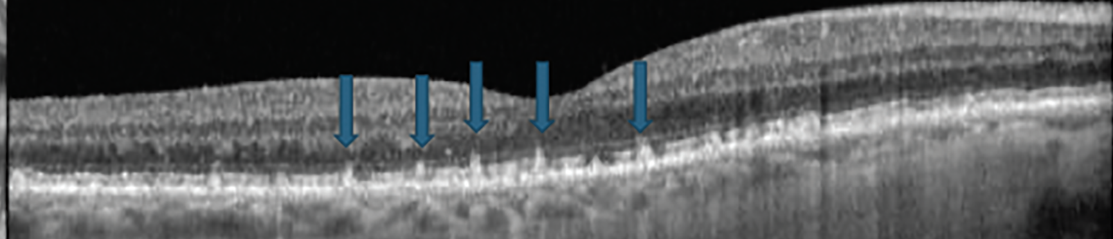 Fig. 5. OCT showing subretinal drusenoid deposits, also known as reticular pseudodrusen.