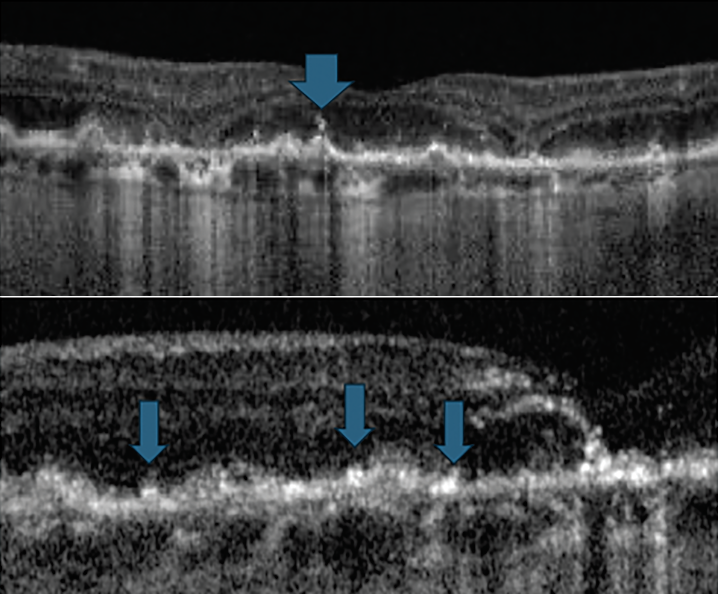 Fig. 6. Hyperreflective foci on OCT.