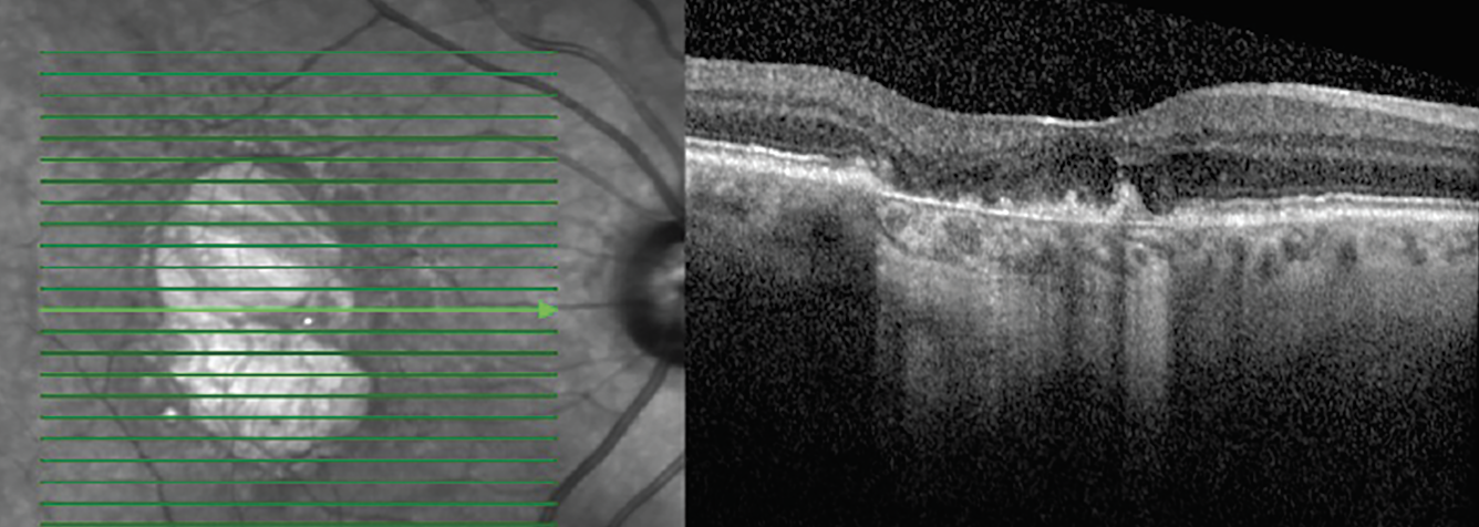 Fig. 7. Hyper-transmission defect on OCT.