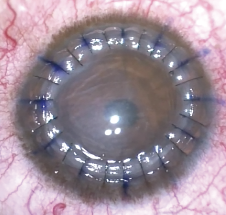 Post-op following PK is crucial, especially the first three months, to monitor for possible complications such as broken sutures or signs of graft rejections. 