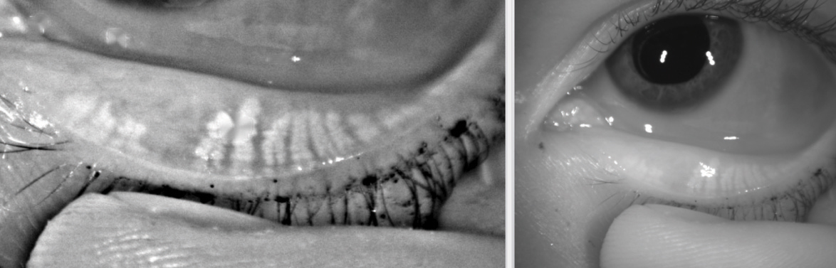 Findings from this study suggest that eyecare practitioners should assess meibomian gland dysfunction and screen for morphological changes such as gland atrophy even in children. 