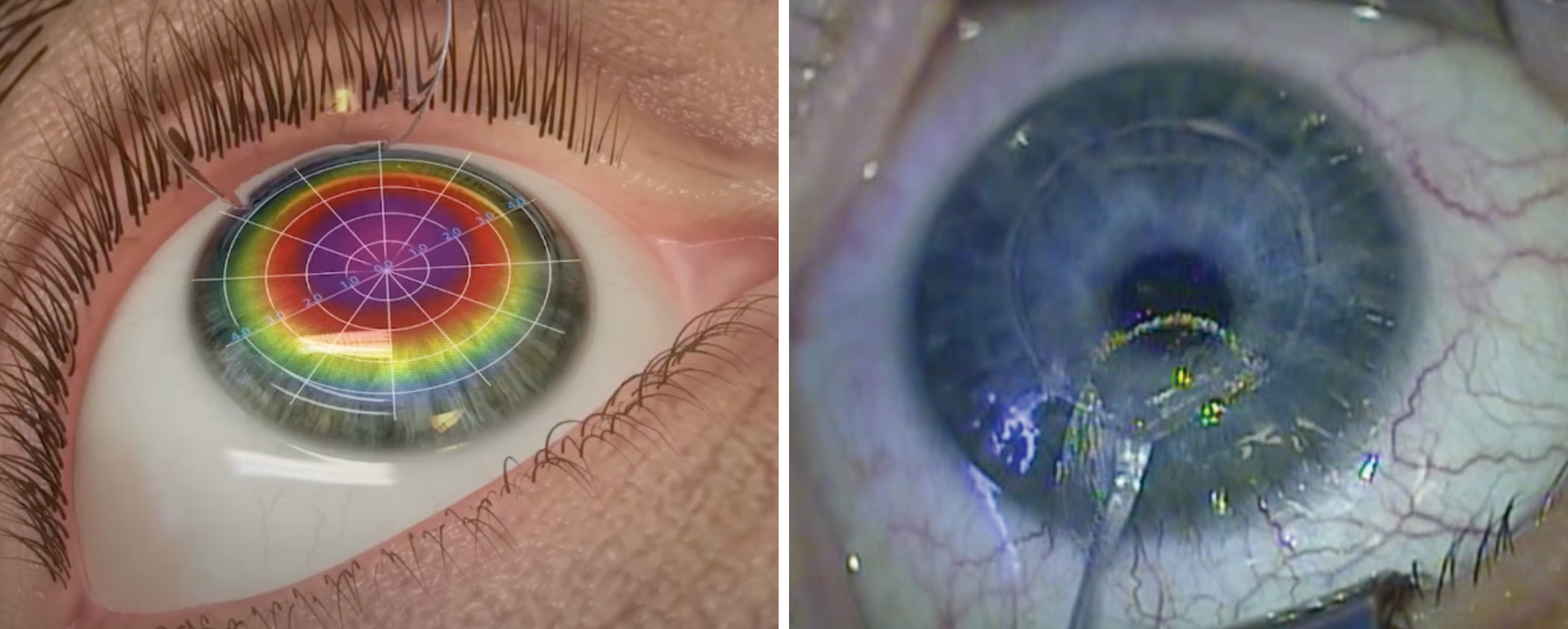 TG-LASIK and SMILE may induce epithelial remodeling by changes in corneal curvature occurring from stromal ablation or lenticule extraction, inciting corneal epithelial cell migration from the limbus. 