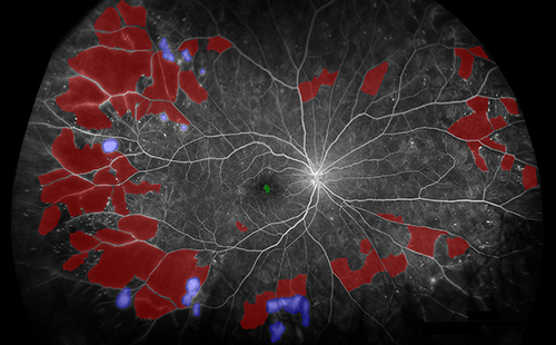 Regular use of UWF imaging during initial diagnosis of DR and for follow-up can allow for more precise grading and monitoring of severity, these authors argue. This image from the study shows segmentation of biomarkers in PDR. Red: nonperfusion, purple: neovascularization. FA images were captured using the Optos 200Tx or California devices in this study and segmented using custom software.