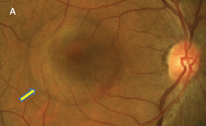 Sex and age are associated to the density of sex-steroid receptors in the human choroid tissue. Young women may derive protection against CSC through choroidal endothelial cells that are less responsive to female sex hormones. 