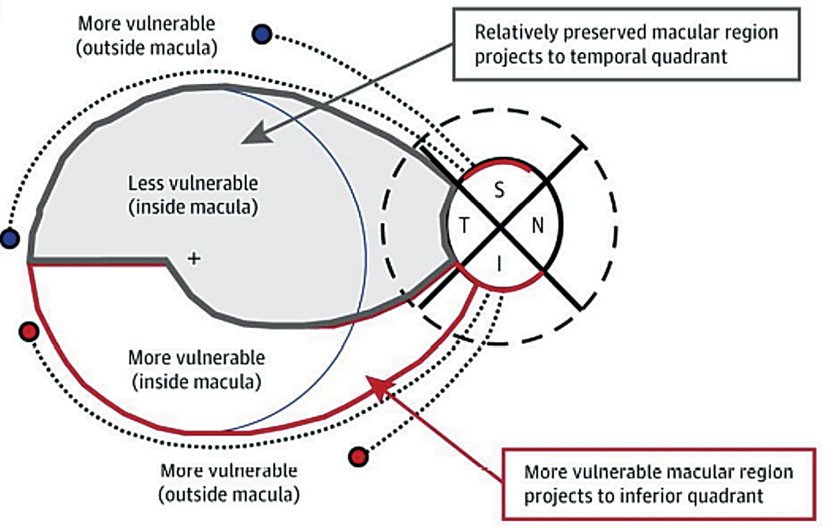 If a patient’s axial length differs more than 1.0mm between eyes, clinicians may observe structural differences in the optic nerve head, thinner RNFL and GCIPL and more rapid vision loss, this study suggests.  This illustration demonstrates the inferior vulnerability zone, which consists of macular fibers that are at risk for damage due to glaucoma. The superior vulnerability zone does not consist of macular fibers.