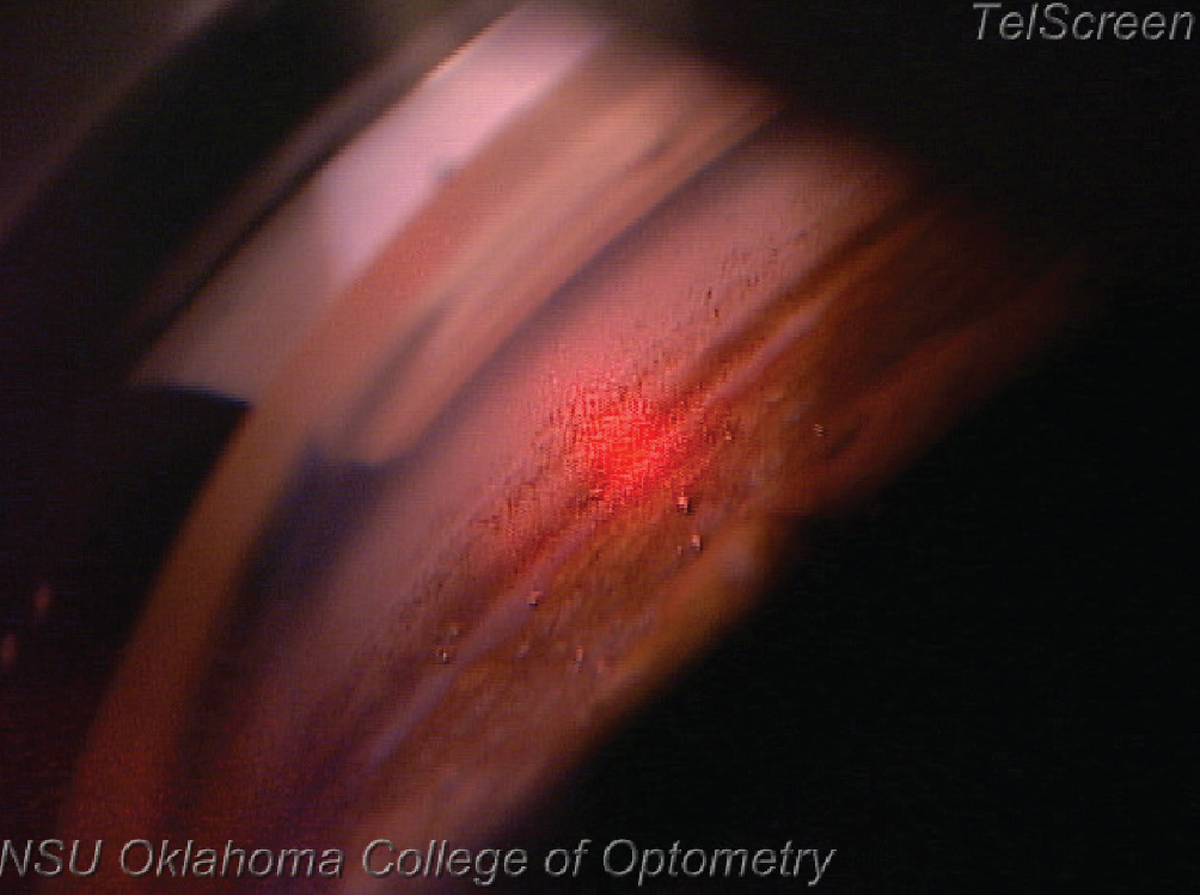 Patients with open-angle glaucoma or ocular hypertension treated with topical medication vs. SLT showed no difference in IOP fluctuation, rate of eyes at target IOP, visual field or quality of life at two, three, six and 12 months of follow-up.