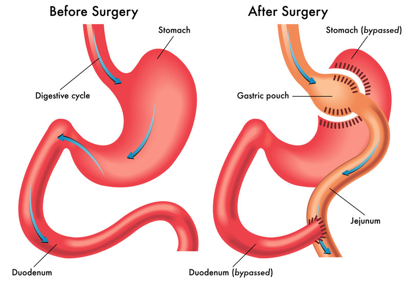 Among patients with type 2 diabetes who underwent bariatric surgery, reductions in BMI and HbA1c were linked with significant improvements in corneal nerve density/length, corneal sensation and clinical measures of peripheral neuropathy, according to these findings. 