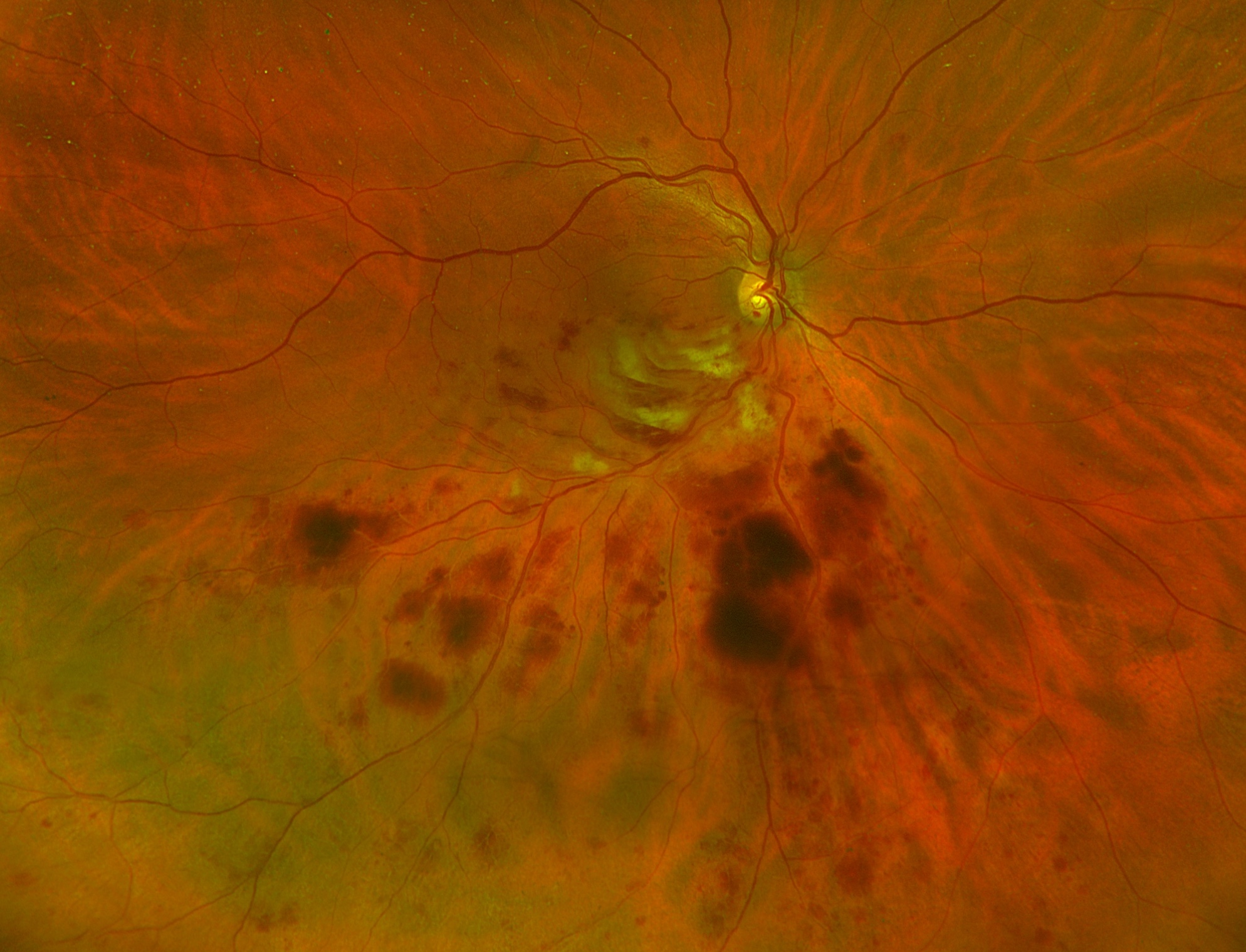 A new analysis showed that structural changes in the choroid among RVO patients receiving intravitreal anti-VEGF therapy could be useful tool during clinical follow-up of these individuals.