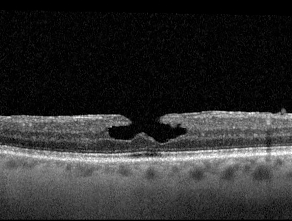 The degenerative subtype of LMH displayed a larger FAZ area, lower parafoveal and perifoveal superficial capillary plexus vessel densities and lower foveal deep capillary plexus vessel densities.