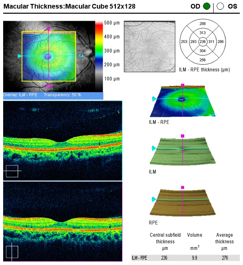 A new study takes a deeper dive into the connection between genetics and disease risk, particularly the role blood type plays in retinal structure indices. Researchers discovered macular thicknesses were significantly higher in participants from the AB blood group, compared to others. They also found that blood type B participants were more likely to have peripapillary RNFL thinning than other blood groups. The authors believe blood type should be considered in the clinical interpretation of retinal structures, but more studies are warranted.