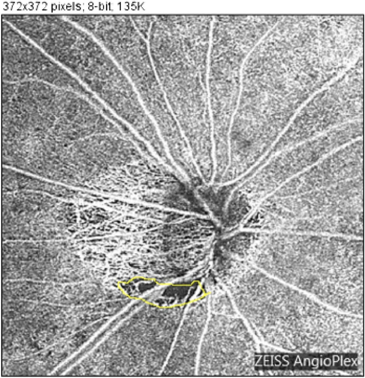 A higher proportion of eyes in the high myopia group transitioned from not showing microvasculature dropout at baseline to developing it throughout the follow-up.