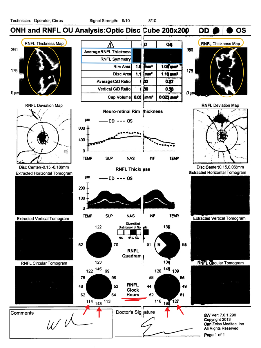 Fig 1. The limitations of black and white printed records of RNFL thickness and deviation maps as well as average RNFL thickness and symmetry make this faxed copy of little use. RNFL clock hours can still be interpreted and compared to future testing.