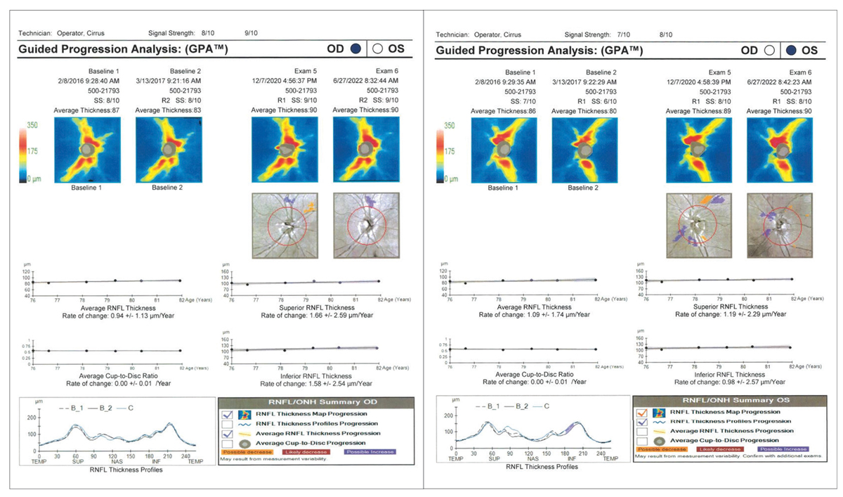 Fig. 2. Robust RNFL OD and OS with no progression.