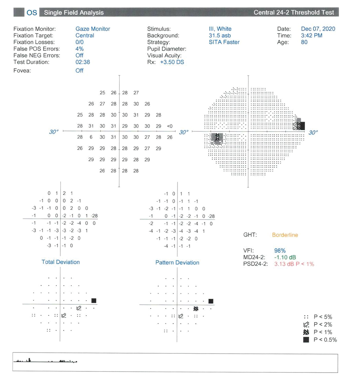 Fig. 3. Superior nasal defect that falls short of cluster criteria.