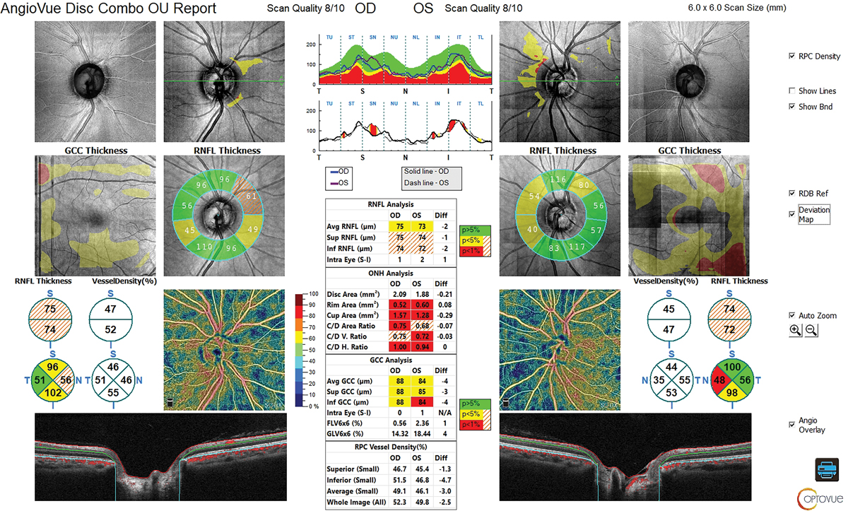 Fig. 4. RNFL and GCC of OCT show reasonable thickness without a glaucomatous pattern.