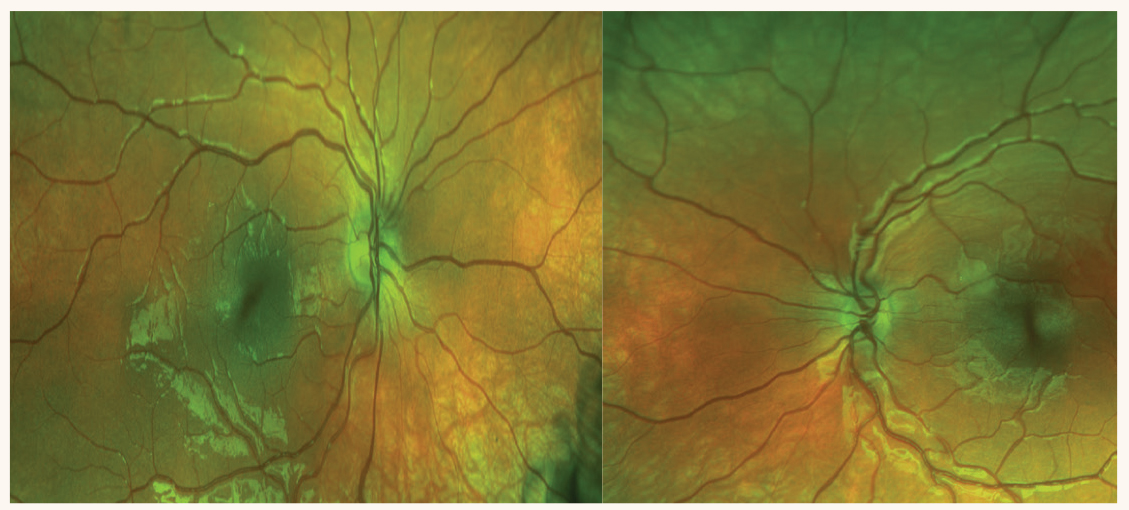 Fig. 1. Fundus photography reveals what appears to be a smaller optic nerve head in the left eye, suspicious for optic disc hypoplasia.