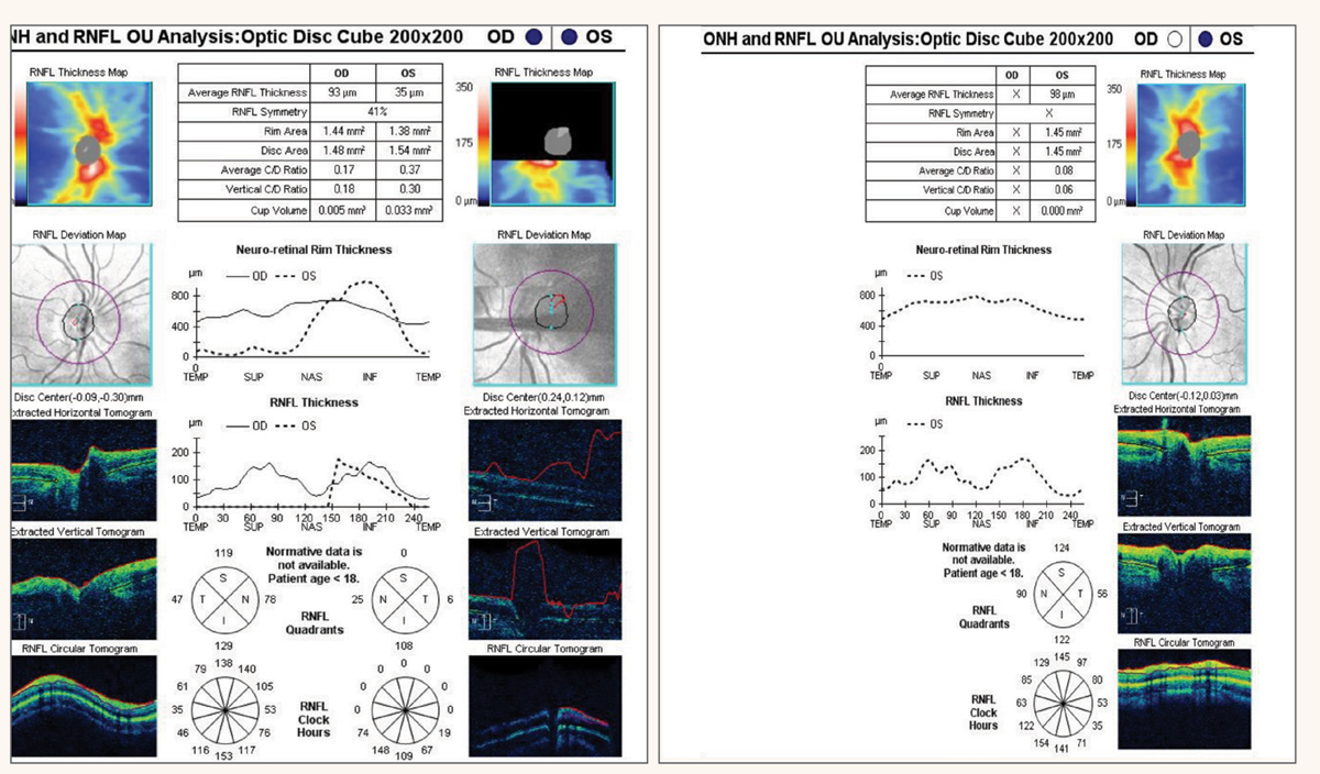 Fig. 2. OCT of the optic nerve head and RNFL on two visits. The patient was not too cooperative on the first visit (left) for the OS but improved on the second visit (right). Both optic nerve heads are normal and the RNFL is full, ruling out optic disc hypoplasia OS. The disc area OD and OS is also similar.