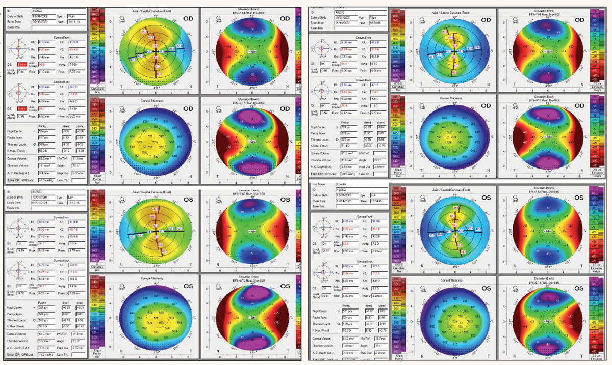 Fig. 3. Pentacam images OD and OS in 2021 (3a, left). Images in 2023 (3b, right). Both show a high degree of astigmatism, increasing in the OD, but regular corneas. The patient had been diagnosed with refractive amblyopia due to the high astigmatism but was correctable to 20/20 and 20/25 with GP contact lenses. This was not refractive amblyopia since the VA was correctable. 