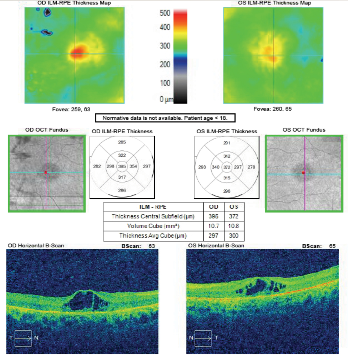 Fig 4. OCT of the macula OD and OS reveals CME in an 11-year-old boy referred for vision training due to reduced vision secondary to “learning disabilities.” 