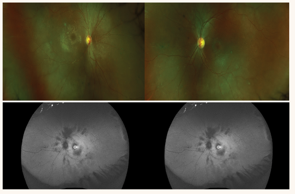 Fig. 5. Color fundus photos reveal attenuated arterioles (top), and the FAF photos reveal retinal hypo-AF indicating diffuse retinal degeneration and small hyper-AF rings in the macula, a sign of advanced retinitis pigmentosa (bottom).