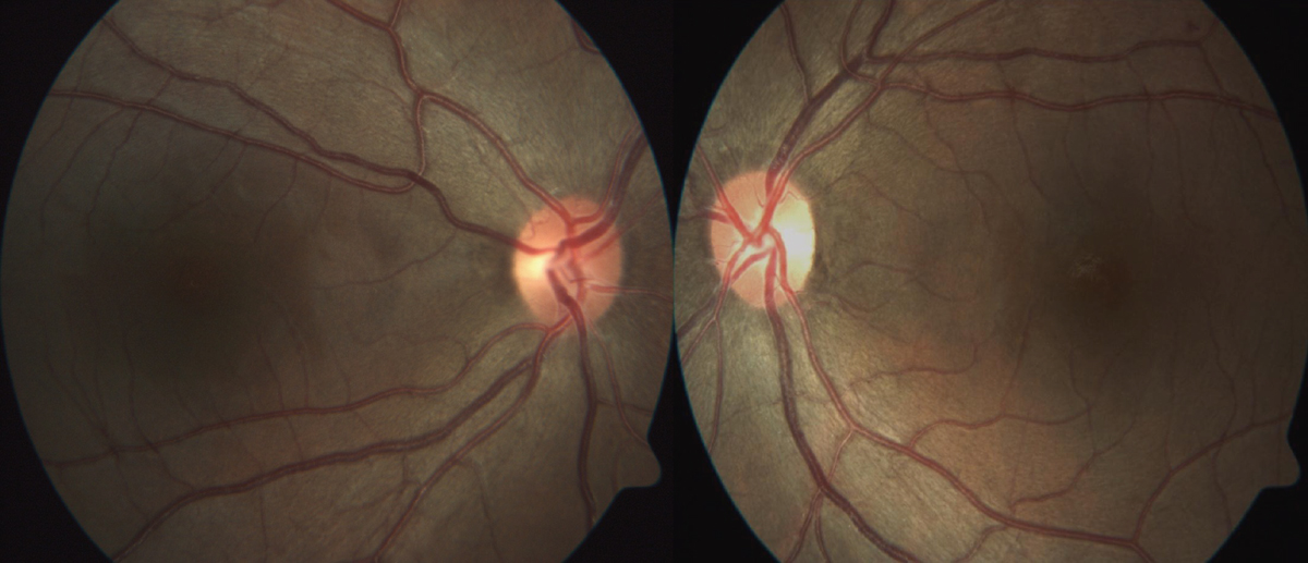 Fig. 6. Fundus photography reveals temporal pallor of both optic nerve heads, more obvious in the left eye.