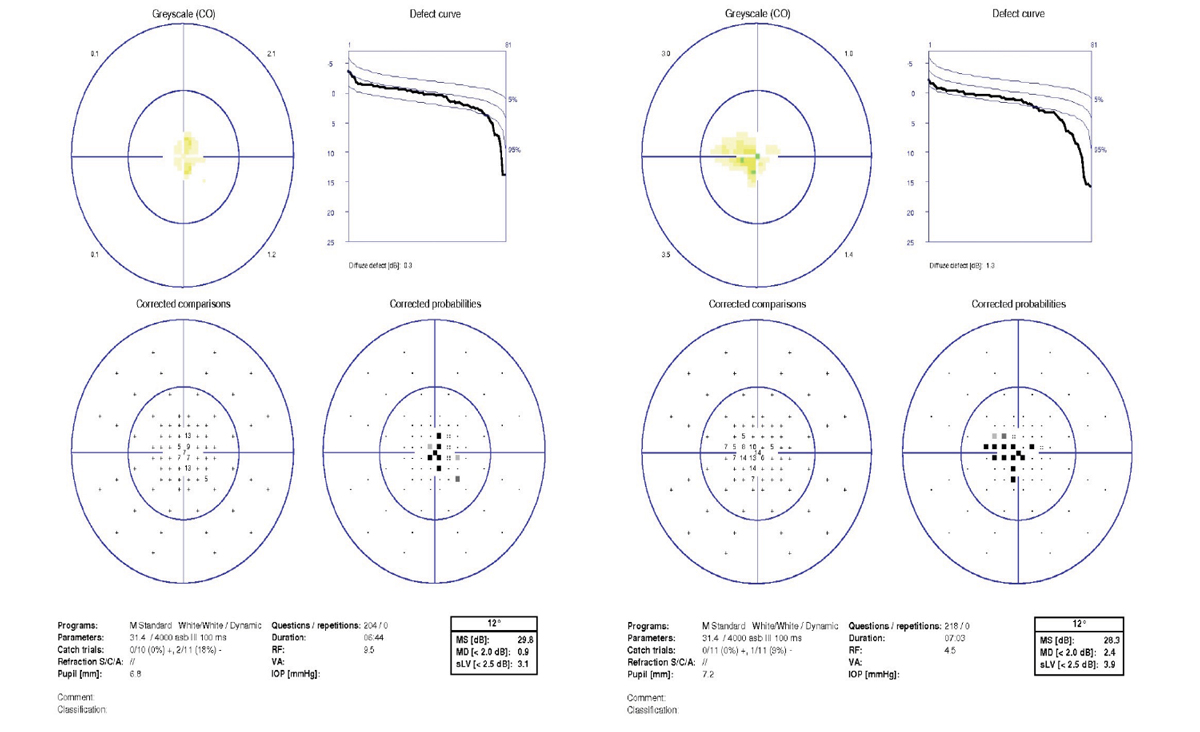 Fig 7. 10º Octopus visual fields reveal a central scotoma in both eyes, greater in the left (red arrows).