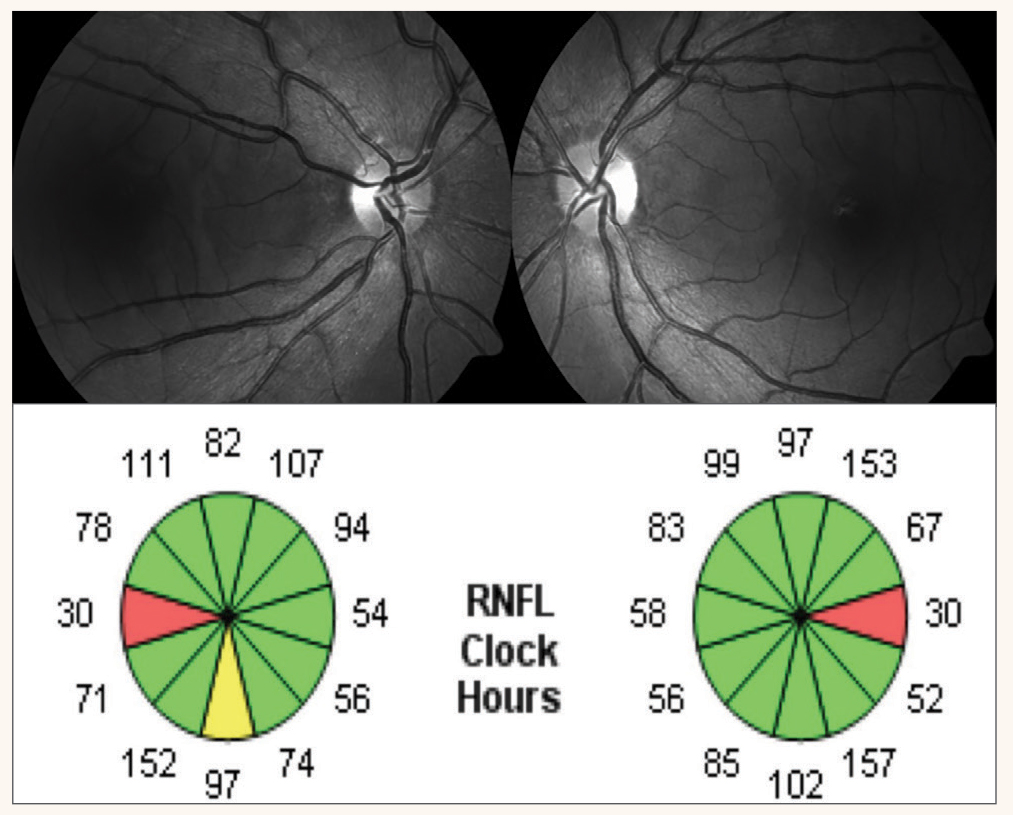 Fig. 8. OCT RNFL clock sector reveals symmetric papillomacular bundle thinning coinciding with the temporal disc pallor and central visual field defects in each eye.