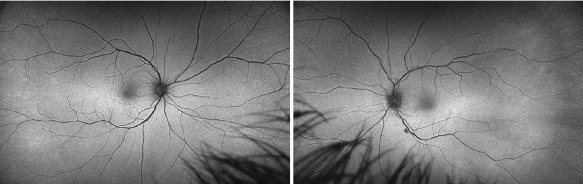 Fig. 2. Optos FA OD (left) and OS (right).