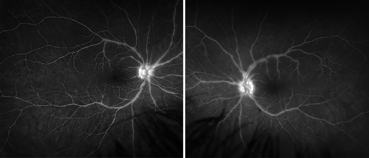 Fig. 4. Late-phase FA OD (left) and OS (right).