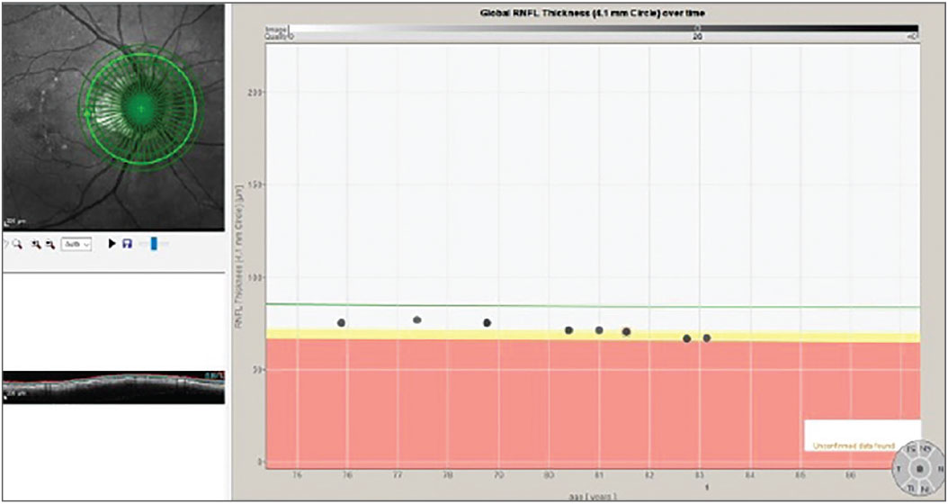 Fig. 3. The progression analysis associated with the 4.1mm diameter RNFL circle scan.