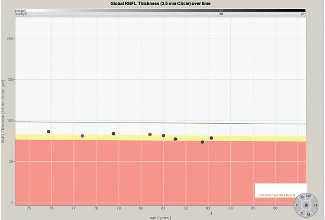 Fig. 2. The progression analysis of the 3.5mm RNFL circle scan of the right eye. Note that the eight individual data points have a slope similar to the decline one would expect due to aging changes, as shown on the green reference line.