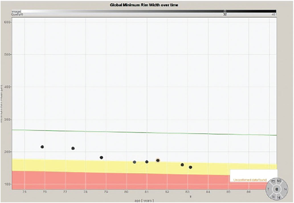 Fig. 5. The progression analysis of the BMO-MRW measurements of the same patient. Note specifically a change (thinning) of the neuroretinal rim metrics after the second scan and again after the sixth scan.