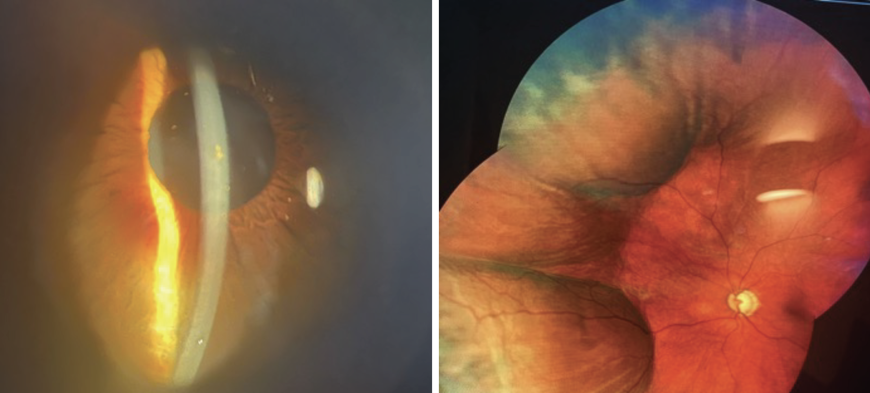 An example of a shallow anterior chamber post-Xen stent in a patient with an IOP of 3mm Hg. Choroidal detachments were confirmed on fundus examination.  