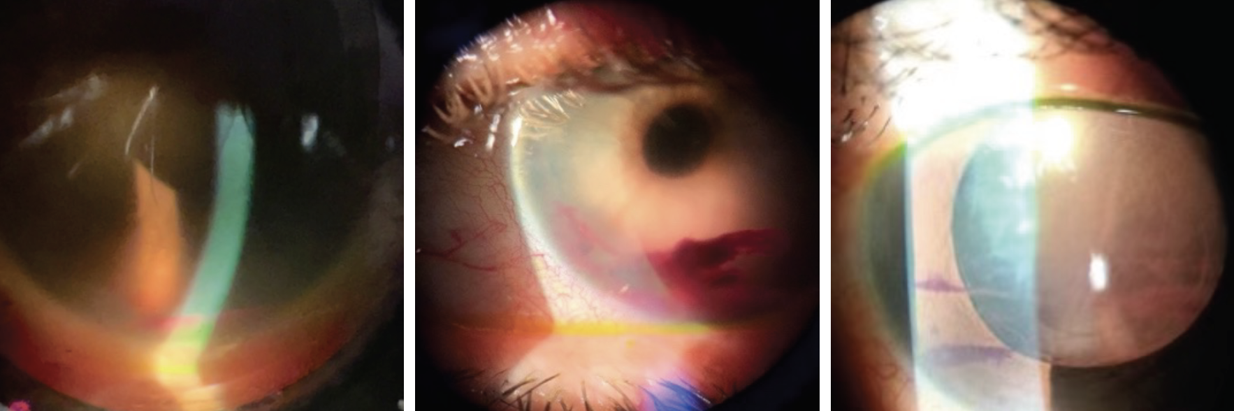 Above are examples of patients with hyphemas post-op day one. 