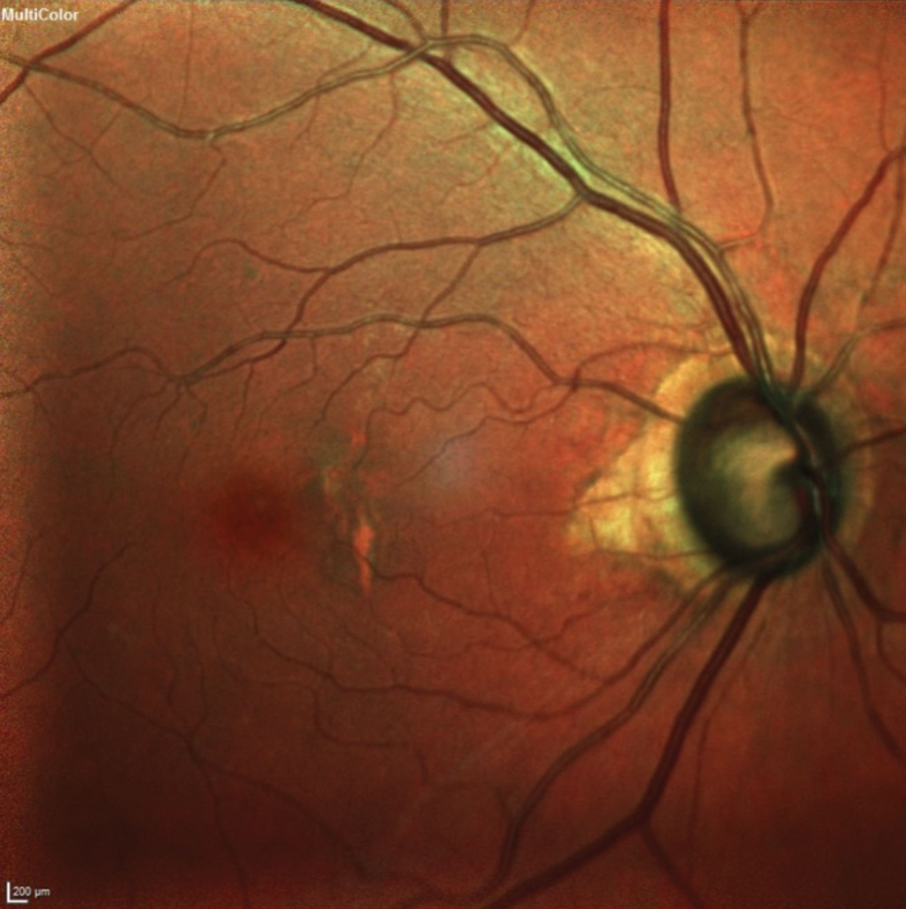 The researchers concluded that “combining canaloplasty with cataract surgery does not compromise the efficacy or safety of the former and might provide a higher absolute IOP reduction and reduced medication burden.”