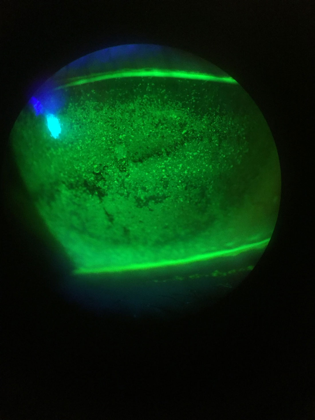 With an increase in axial length, researchers observed a significant increase in the incidence and severity of dry eye among patients with myopia. They recommend measuring ocular biometric parameters in myopic patients during clinical evaluations to help identify dry eye symptoms early and assess the condition’s severity.