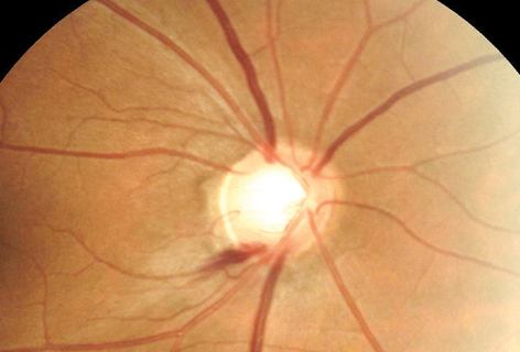 Office-based BP measurements cannot sufficiently and accurately predict individuals with the lowest BP values identified using 24-hour BP recording, leading the study authors to argue for its use in patients at risk of glaucoma progression, particularly those who demonstrate optic disc hemorrhage.