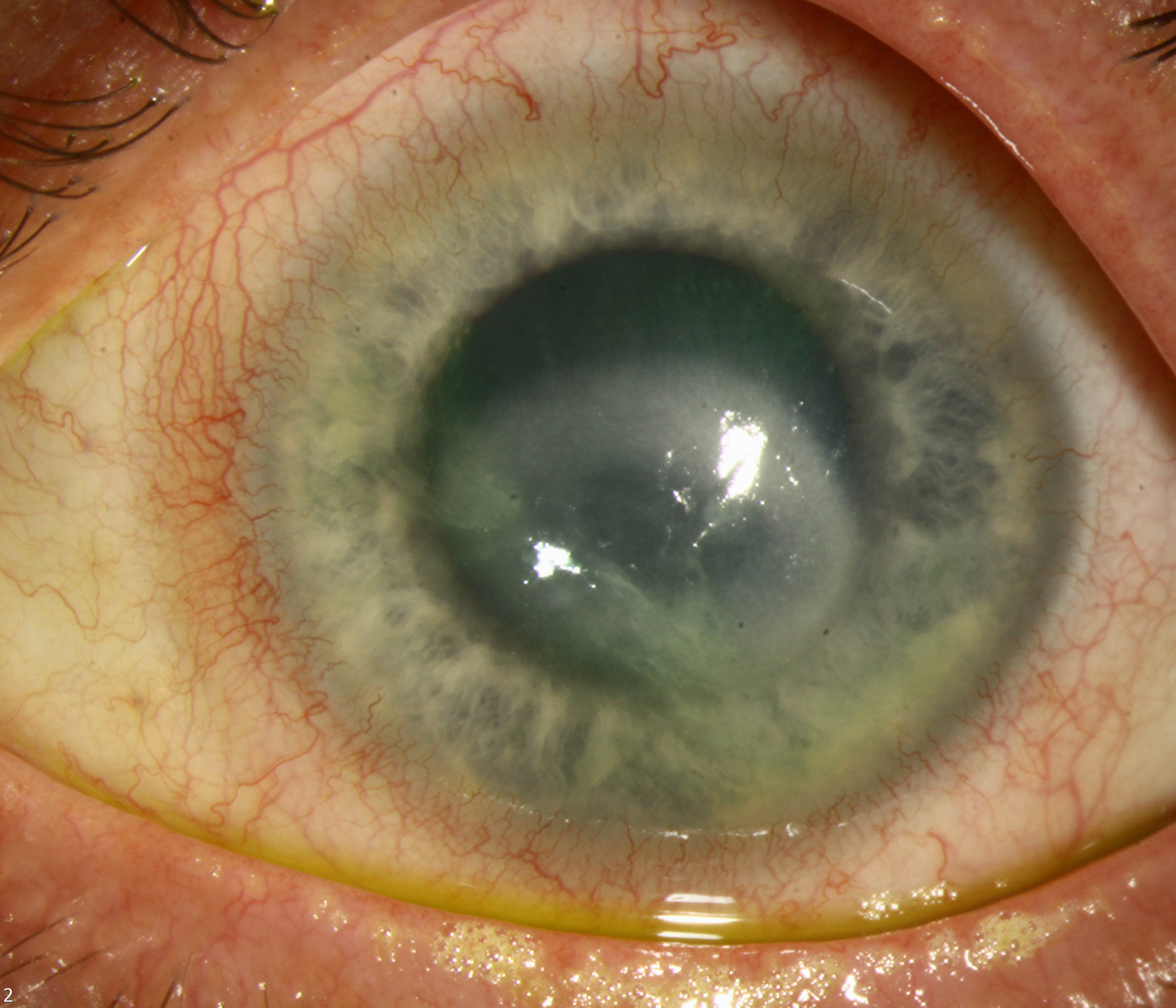 Data suggests that Acanthamoeba keratitis is a relatively low-incident condition, with no significant differences in incidence found among different continents.