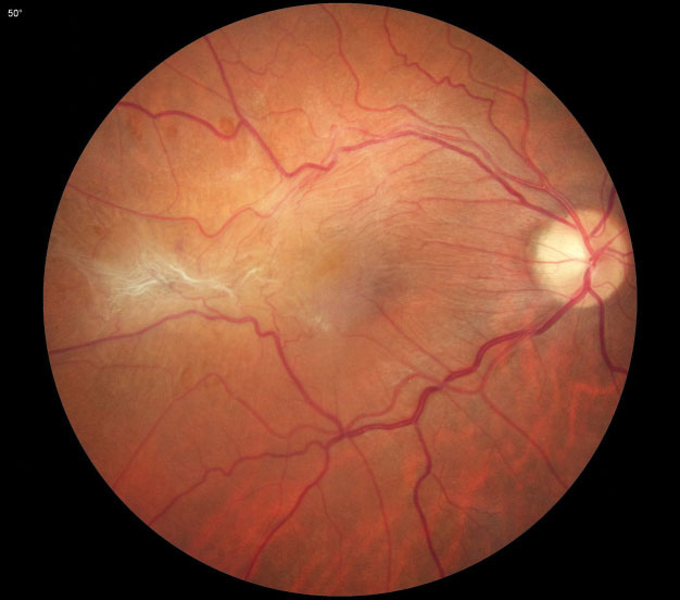 Epiretinal membrane and rhegmatogenous retinal detachment are both associated with metamorphopsia. ERM contraction may compress photoreceptor distribution in the macula, causing macropsia, and macula-off retinal detachments resulting in photoreceptor separation have been associated with micropsia.