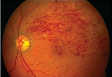 In this analysis of patients with cystoid macular edema due to retinal vein occlusion and initial good visual acuity, the majority of participants received intravitreal therapy and maintained good visual acuity over follow-up period of two years.