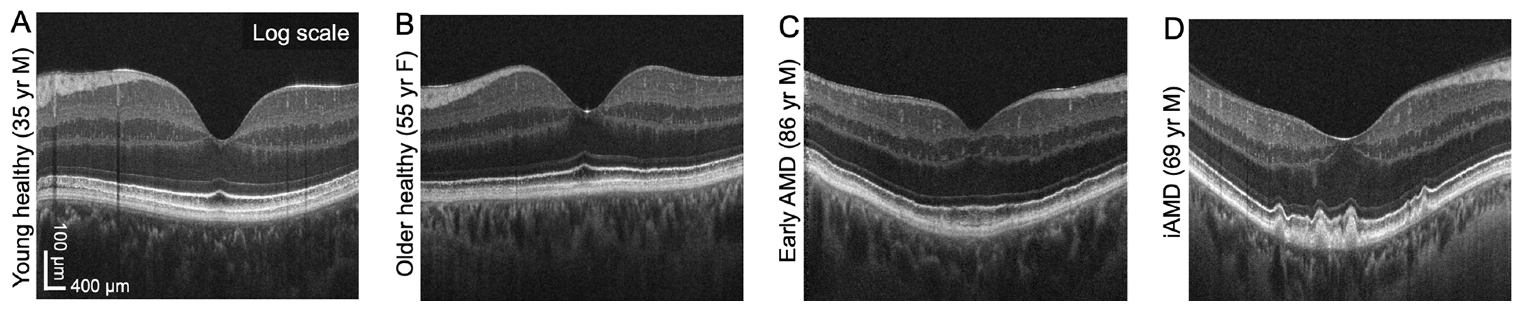 This set of images from the study shows B-scan visualizations of hyporeflective band vi thickness in normal aging and AMD.